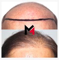 MAXIM Hair Restoration image 3